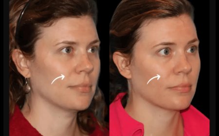 Best Doctors in Dubai Reveal Top Sculptra Fillers Cases