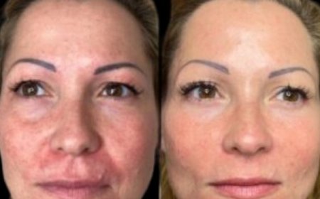 Cultivate Youth through Profhilo at Best Aesthetic Clinic in dubai