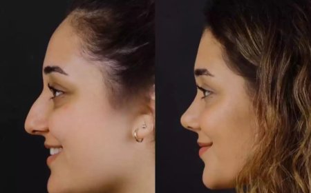 What Sets the Best Doctors in Dubai Apart in Septoplasty Procedures?