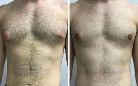 The Best Clinics for Gynecomastia Surgery in Dubai