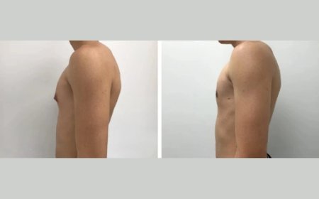 Gynecomastia Treatment Options in Dubai: From Diet to Surgery