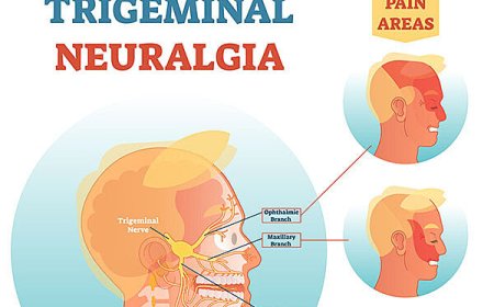 Early Signs of Trigeminal Neuralgia and When to See a Doctor