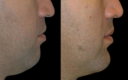 Why Choose the Best Doctors in Dubai for Your Chin Fillers Procedure