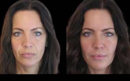 Meet the Best Doctors in Dubai for Jawline Fillers