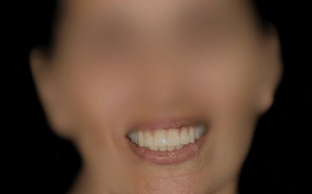 Estética Dental en Hospitalet de Llobregat Transforma tu Sonrisa