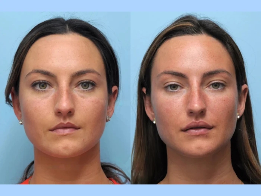 Age Gracefully with the Best Plastic Surgeons in Dubai for Thread Lift