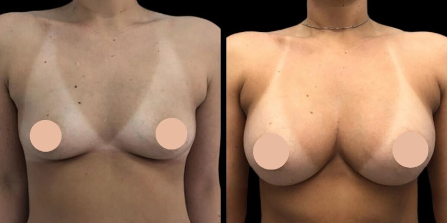 Planning Breast Augmentation Surgery in Dubai? Start Here
