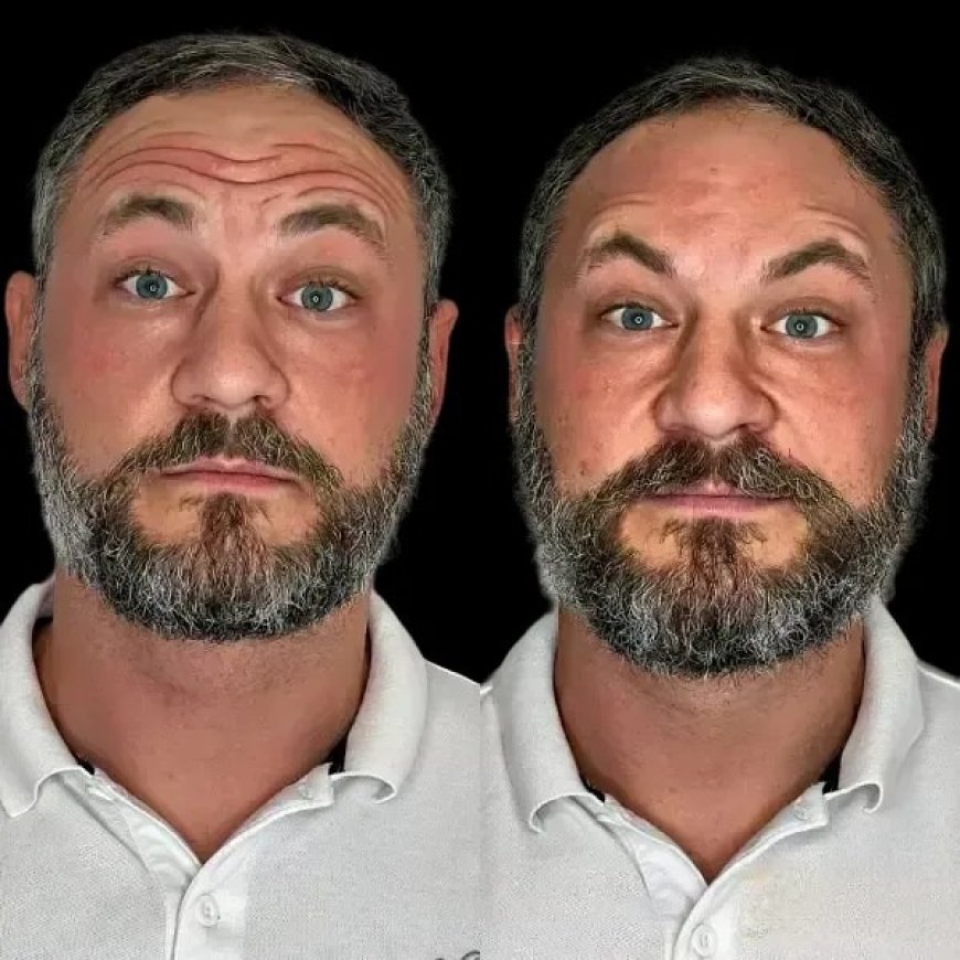 Enhance Youth with Profhilo by the Best Doctors in dubai