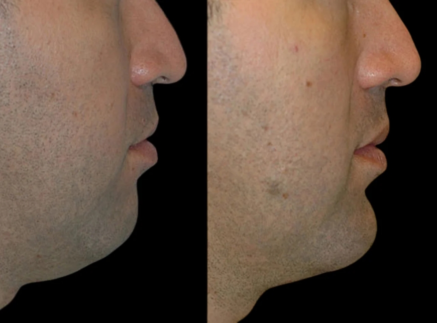 Why Choose the Best Doctors in Dubai for Your Chin Fillers Procedure