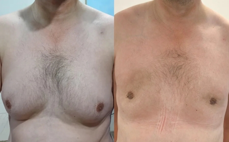 Transform Your Confidence with Gynecomastia Surgery in Islamabad