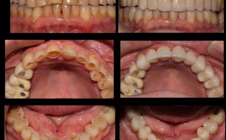 Blanqueamiento Dental en Hospitalet de Llobregat Dientes Más Blancos y Brillantes