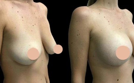 Choosing the Right Implant Size with Help from the Best Breast Augmentation Surgeons in Dubai