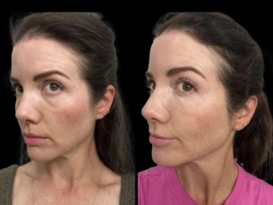 Best Aesthetic Clinics in Dubai for Long-Term Dark Circles treatment Solutions