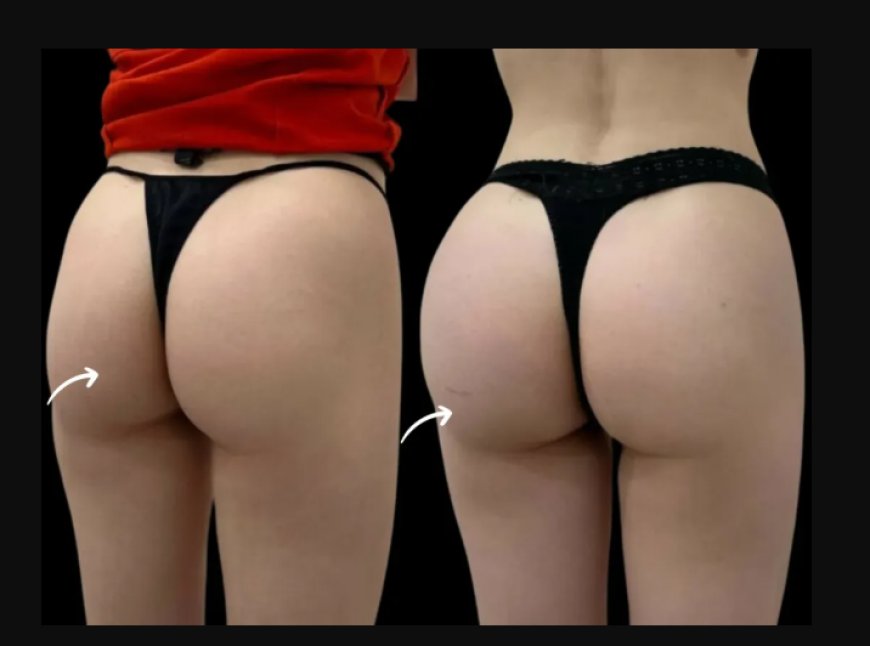 Butt Lift Without Surgery: Sculptra Fillers in Dubai Explained