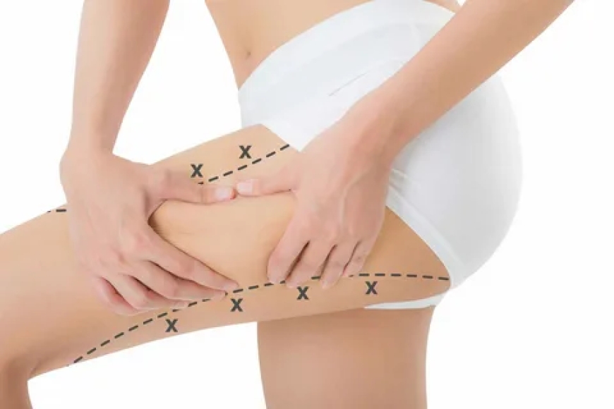 Liposuction and Diet: How Nutrition Affects Your Results