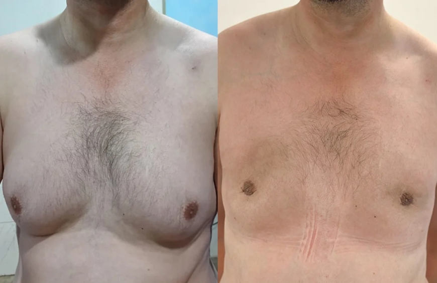 Transform Your Confidence with Gynecomastia Surgery in Islamabad