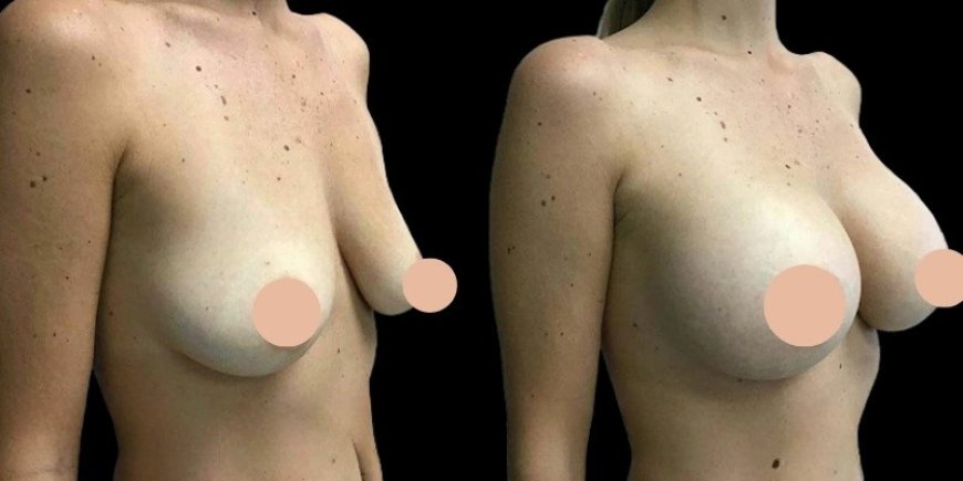 Choosing the Right Implant Size with Help from the Best Breast Augmentation Surgeons in Dubai