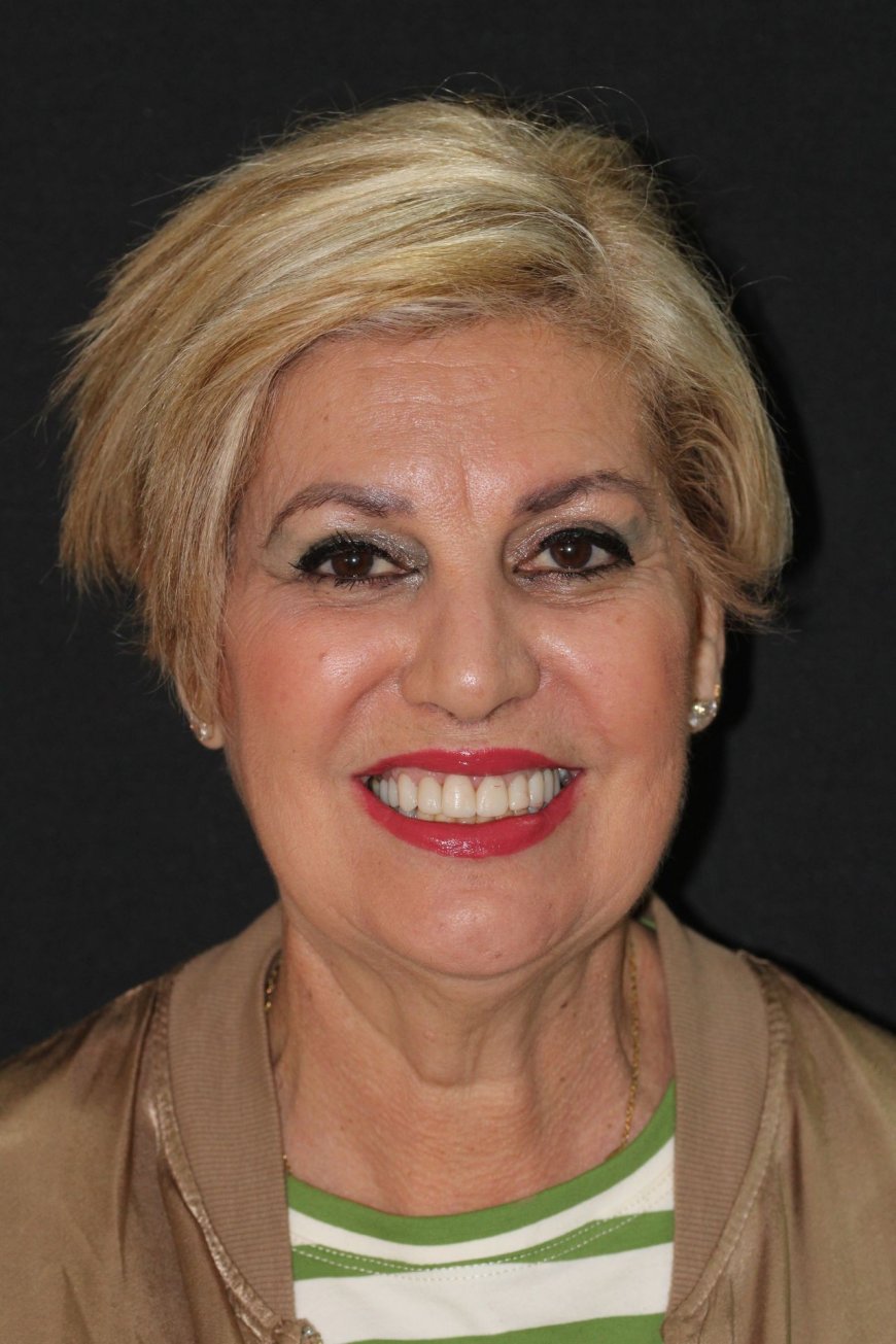 Implantes Dentales en Hospitalet de Llobregat Soluciones Efectivas para tu Sonrisa